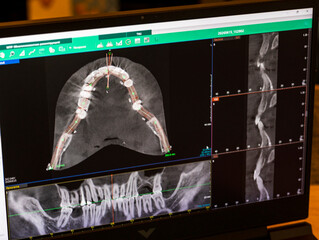 Laptop screen displaying professional dental diagnostic software with a 3D panoramic jawbone model and cross-sectional root slices. Dental © Four_Lakes
