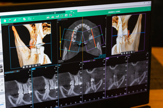 Laptop screen displaying professional dental diagnostic software with a 3D panoramic jawbone model and cross-sectional root slices. Dental