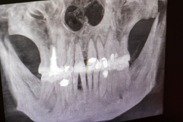 Dental CBCT software interface featuring a 3D volumetric maxillofacial reconstruction alongside axial, sagittal, and coronal multi-planar slices. dental © Four_Lakes