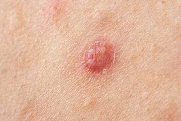 Fototapeta premium Acne with visible pores. Acne with inflamed pimple. Acne with skin blemishes. Acne around inflamed pustule.