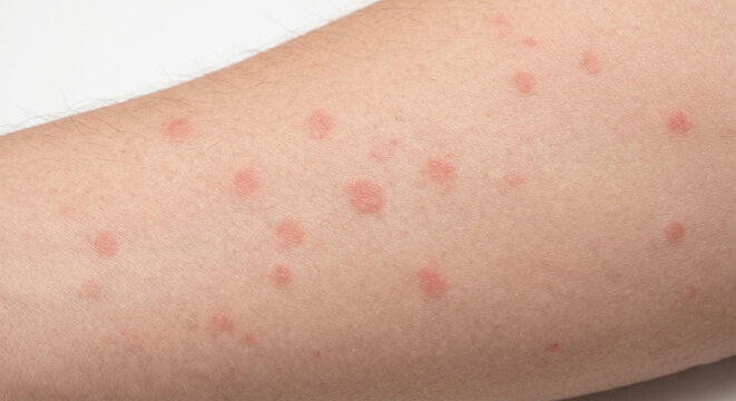 Rubella Macule - Macule in Human Skin &mdash; Medical Dermatology Plate (20-100)
