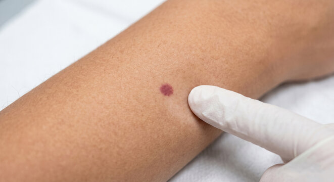 Petechial Macule - Macule in Human Skin &mdash; Medical Dermatology Plate (21-100)