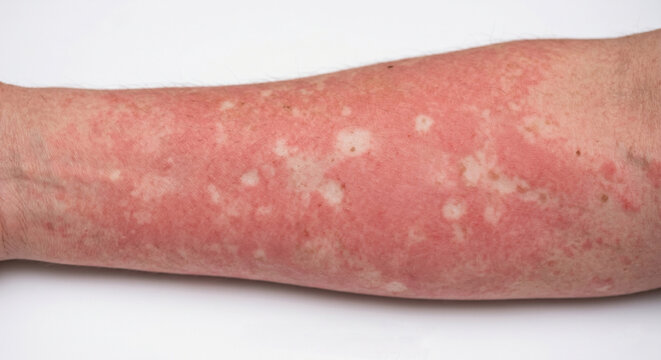 Dengue Fever Macule  -- Macule in Human Skin &mdash; Medical Dermatology Plate (27-100)