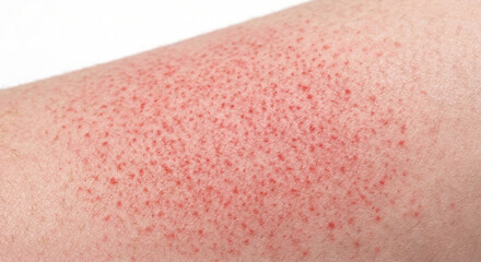 Fototapeta premium Scarlet Fever (Scarlatiniform) Macule - Macule in Human Skin — Medical Dermatology Plate (28-100)