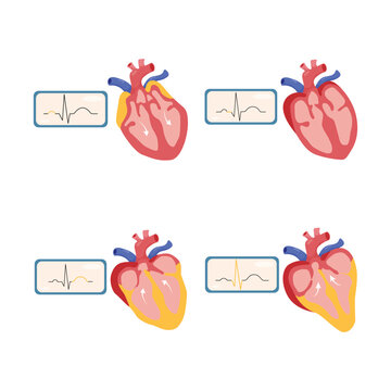 Heart Rhythm Disorder Medical Illustration Set