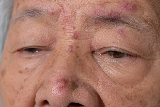 Elder Zoster Eye Close Up of Healing Herpes Zoster Ophthalmicus Lesions on Forehead and Nose Bridge with Hutchinson Sign in Senior Patient