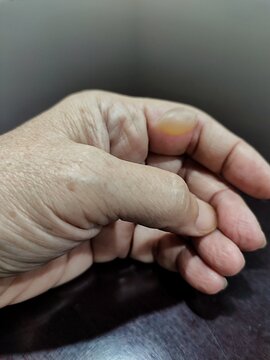 Close-up of a human finger with a fluid-filled blister caused by friction or burn, isolated on a wooden table background, illustrating a common skin injury.