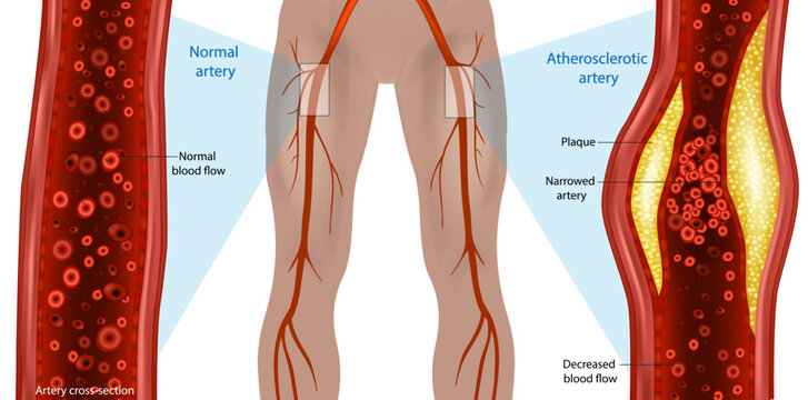 Peripheral Artery Disease Comparison with Normal and Atherosclerotic Femoral Artery Cross Section Medical Illustration. Plaque Formation and Reduced Blood Flow Anatomy Diagram