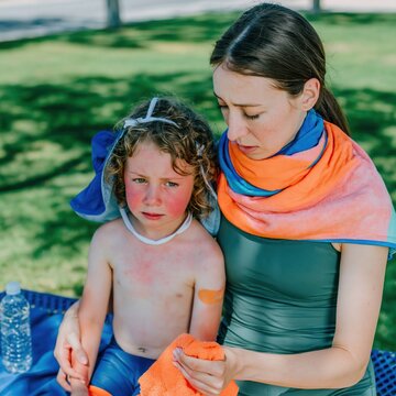Young child with flushed red face and sunburn resting in the shade with a caregiver for heat exhaustion treatment and summer safety awareness
