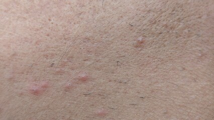 Fototapeta premium Extreme Close-Up of Human Skin Surface Showing Small Red Pimples Folliculitis and Body Hair for Dermatology