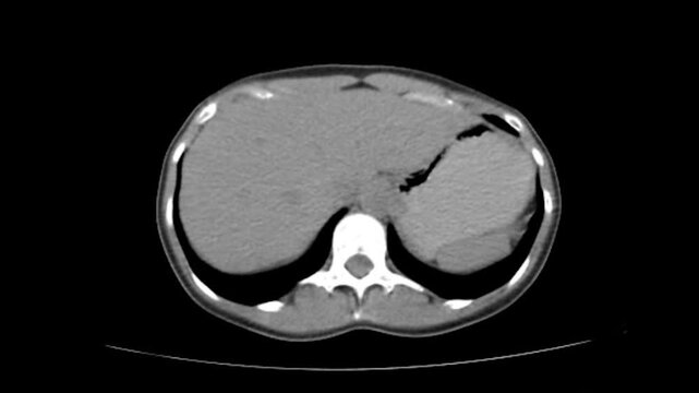 CT scan abdomen x-ray image and MRI abdominal scan. radiologic and radiology.