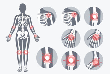 Fototapeta premium Diagram of a human body with highlighted red circles on joints indicating arthritis, chronic pain, or inflammation for medical use.