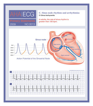 Sinus tachycardia is defined as a sinus rhythm with a rate exceeding 100 beats per minute. It is a type of supraventricular tachycardia caused by enhanced automaticity of the sinoatrial node.
