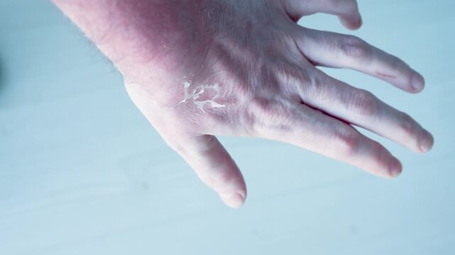 Close Up of Sunburned Hand with Peeling Damaged Skin