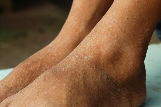 dry, scaly, and irritated skin on children's feet