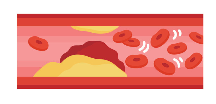 血栓を伴う動脈硬化した血管の断面イラスト