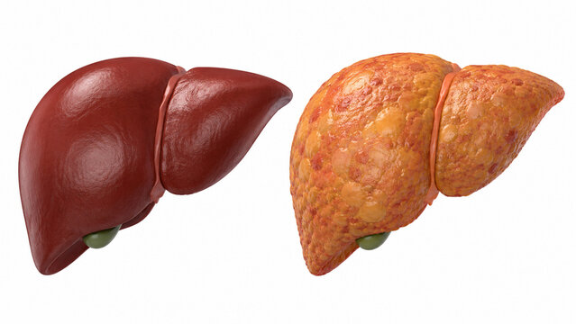 Healthy liver and fatty liver medical comparison concept