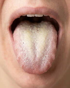 White coated tongue in closeup view
