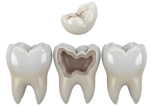 Dental inlay and onlay restoration process showing a damaged tooth being repaired by dentist