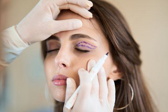 Professional surgeon marks the upper eyelid of a woman with a medical pen to map out the blepharoplasty surgical plan
