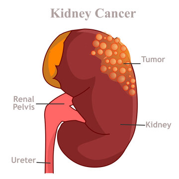 Kidney cancer disease. Urinary system problems. Renal cell carcinoma is the most common type of kidney cancer. Illustration vector