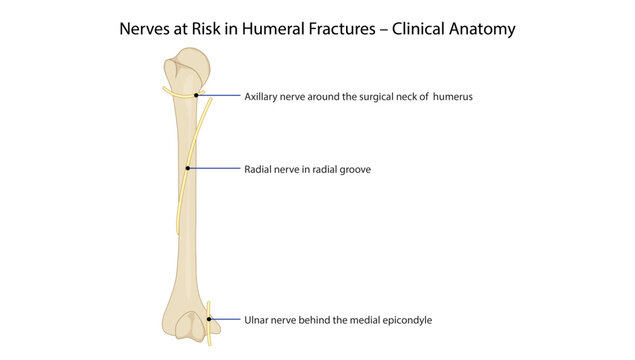Nerves at Risk in Humeral Fractures, the axillary, radial, and ulnar nerves in relation to common fracture sites of the humerus and distal arm.