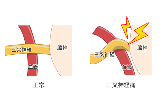 血管が三叉神経を圧迫して痛みが生じるメカニズムの解説図（医療、解剖学資料）