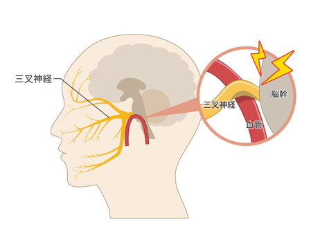 血管が三叉神経を圧迫して痛みが生じるメカニズムの解説図（医療、解剖学資料）
