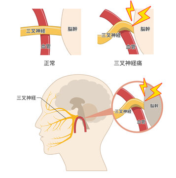 血管が三叉神経を圧迫して痛みが生じるメカニズムの解説図（医療、解剖学資料）