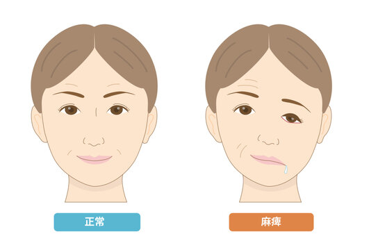 顔面神経麻痺による顔の左右非対称と症状の比較イラスト
