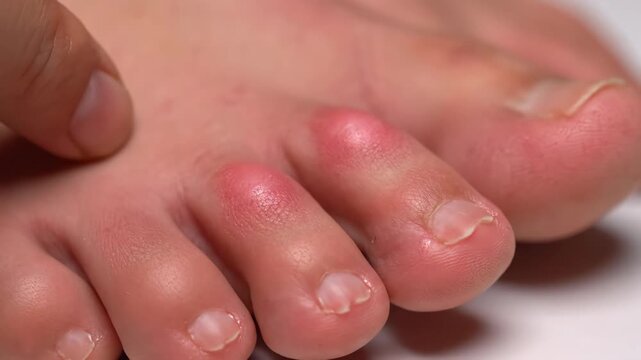 Macro Close Up of Toes Affected by Urticaria Hives and Skin Allergy Reaction, 4K
