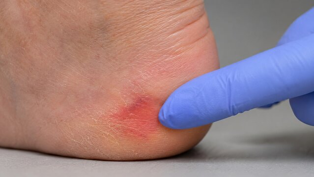 Doctor examining painful blister on heel of woman. Medical professional checking skin inflammation and corn on foot. Healthcare podiatry diagnosis and treatment of foot injury concept.
