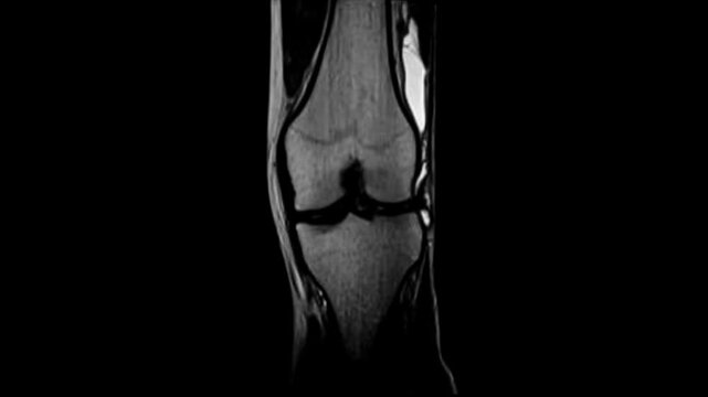 MRI Scan of a Human Knee Joint