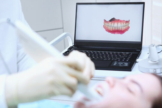 Dentist performs 3D scan of patient's teeth. Dentist holds portable 3D scanner in his hand to examine jaw and oral cavity. Condition of teeth. Model of teeth and gums on medical monitor. Patient's fac