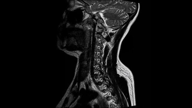  MRI Scan of the Cervical Spine