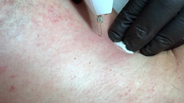 Close-up of mole and skin tag removal with electrocautery device during dermatology procedure. Healthcare, precision, cosmetic treatment, skin care, medical technology.