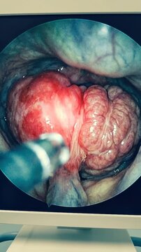 Internal gland pathology: male organ, disease study, prostatic adenoma, clinical imaging, anatomical atlas, pelvic structure, inflammatory condition, urology procedure.