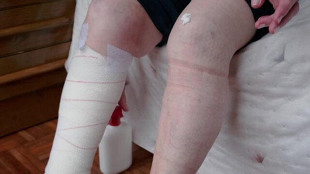 Woman applying moisturizing cream on varicose veins