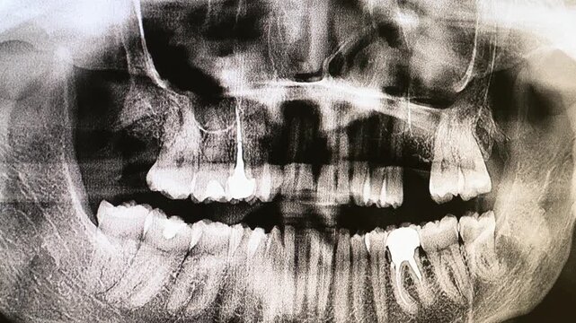 Dental X ray image displayed on a monitor for examination and treatment planning. Digital dental radiography used for oral diagnostics, implant planning, orthodontics and modern dental care. High