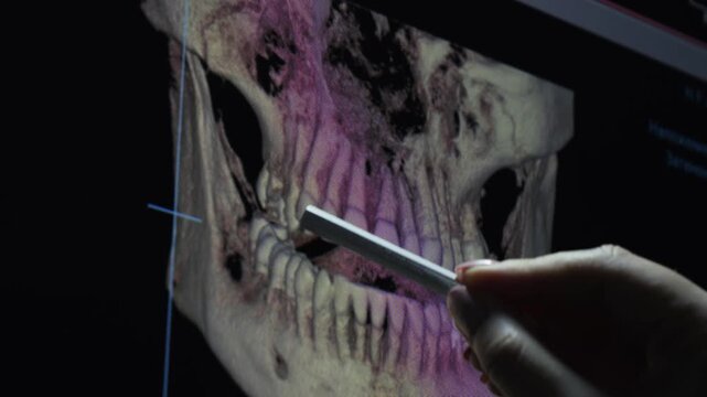 Close up of a dentist analyzing a three dimensional dental CT scan displayed on a monitor and pointing at the jaw with a stylus. Modern digital dentistry. High quality 4k footage