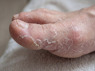 Fototapeta premium This close up shows dry and flaky skin on a human foot. The focus is on the toes and the surface of the skin. It appears rough and cracked. This could relate to podiatry or skin care