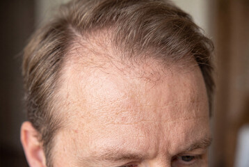 Fototapeta premium A close up of a frontal hairline with visible thinning and sparse hair. The subject appears to have natural hair loss occurring on the scalp