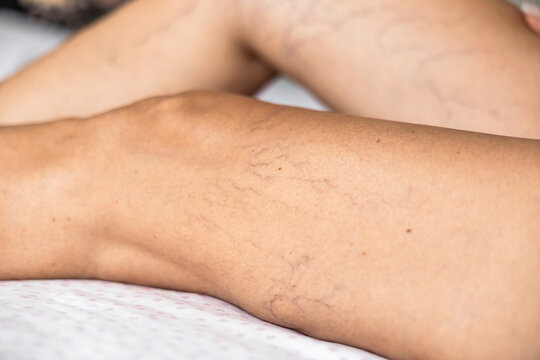 Close-up of lower leg with spider veins and superficial telangiectasia. Visible vascular changes associated with chronic venous disease, phlebology, vascular diagnostics, prevention, and medical healt