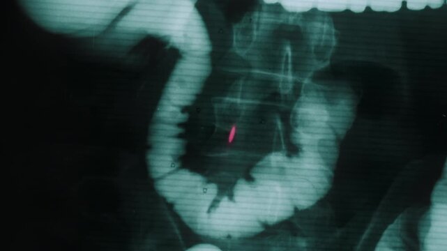 Medical scan of a large intestine showing a polyp highlighted for diagnosis and analysis