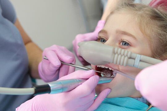 Superficial sedation in treatment of baby teeth. Treatment of children's teeth with nitrous oxide sedation. Modern dentistry