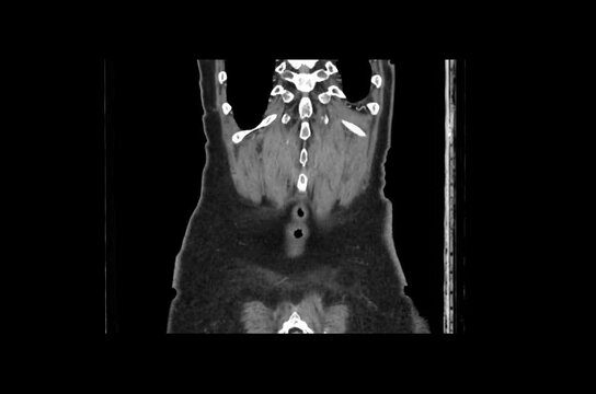 Contrast-Enhanced CT Abdomen and Pelvis Arterial Phase Coronal 1.25 mm DICOM Medical Imaging Anatomy Loop