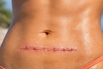 Fototapeta premium A close-up view of an abdominal wound, often seen in medical or emergency situations