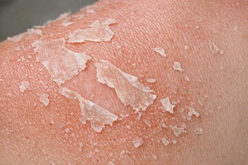 Fototapeta premium A close-up shot of a person's arm featuring a visible skin patch, suitable for use in medical or health-related contexts