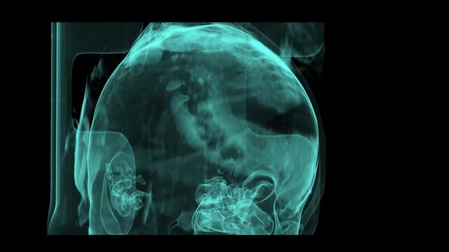 Volume rendered 3D CT scan displaying a complete frontal view of a human skull defect for cranioplasty implant modeling