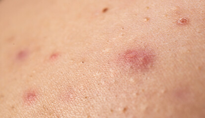 Fototapeta premium Acne skin pimple. Skin problem with acne bumps. Irritated Acne texture. Close up Acne issue.